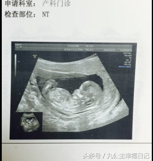原来怀孕三个月NT检查已经可以看出胎儿轮廓！